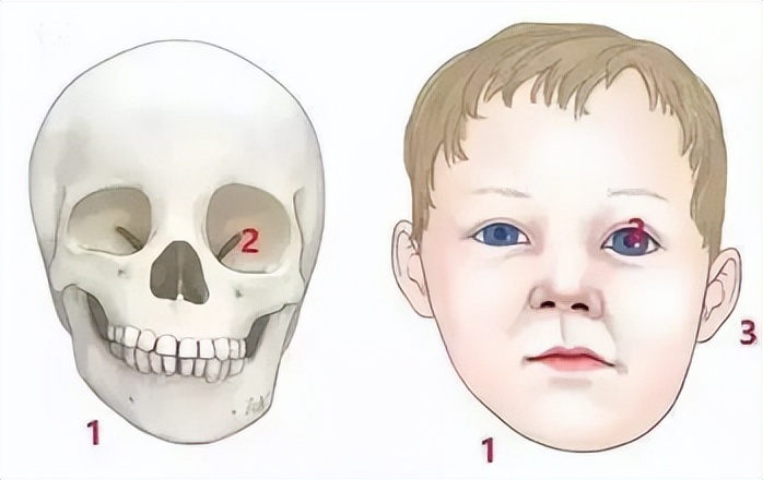 半侧颜面短小症是什么原因导致的,半侧颜面畸形如何改善