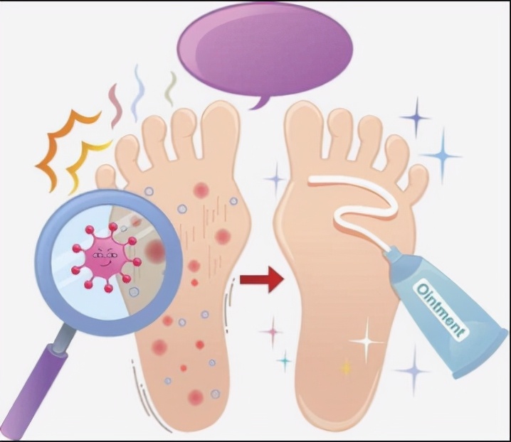 手癣足癣病因,足癣手癣病因