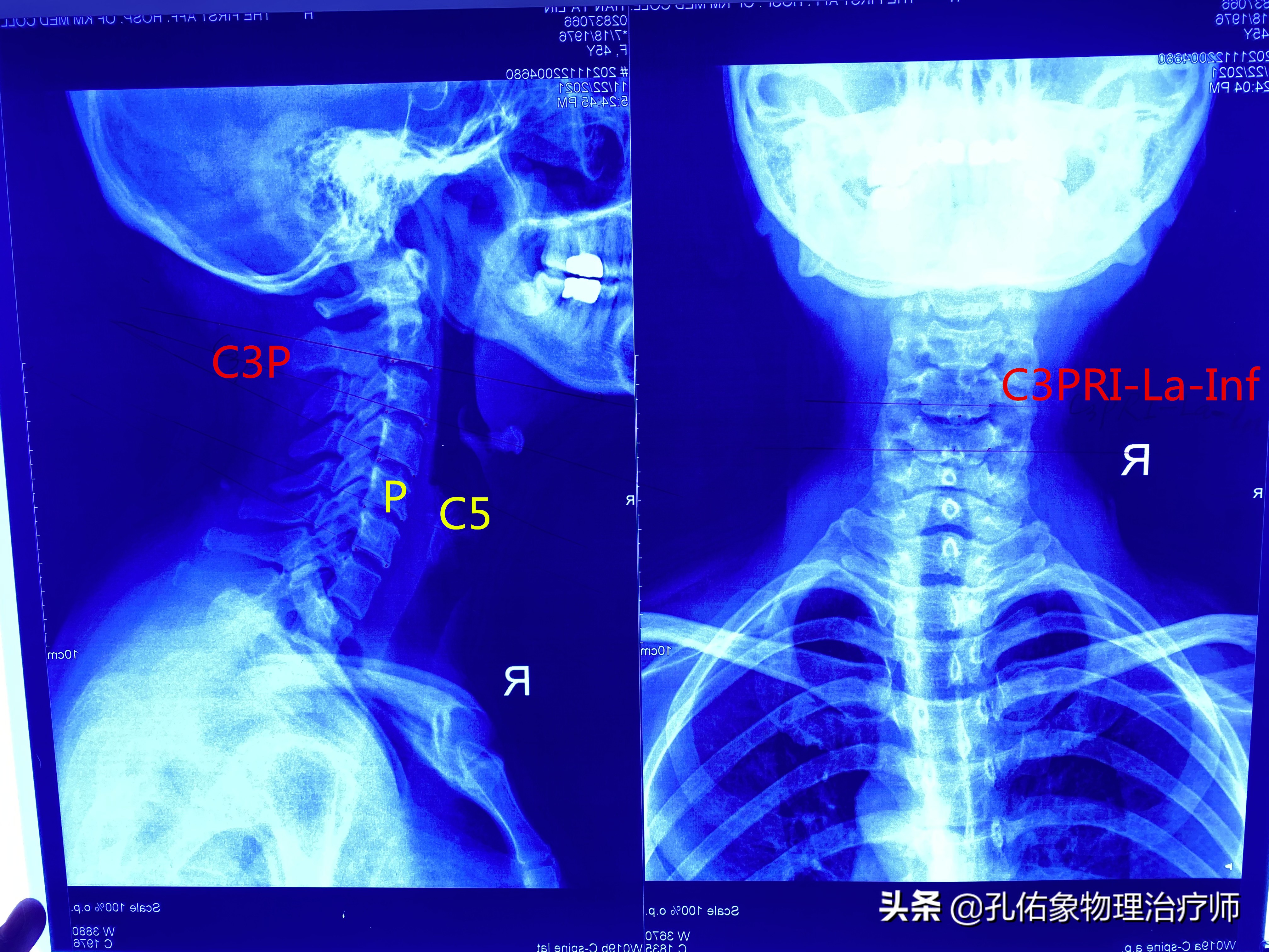 后背肩胛骨疼什么原因造成的,右后背肩胛骨下角疼痛部位对照表