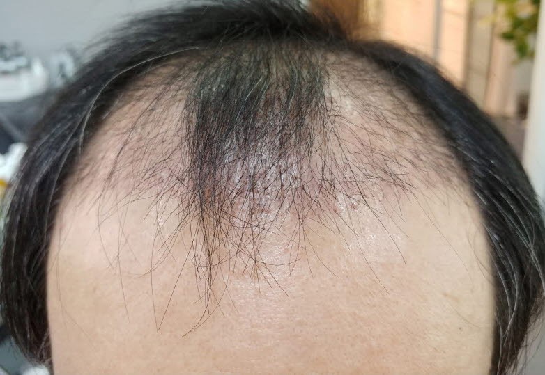 植发后又掉头发是什么原因,植发过后头发还是稀疏怎么办