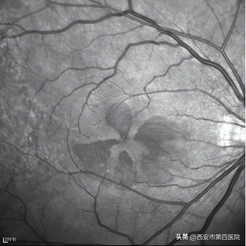 #新冠防疫手册#33岁女士“阳康”后视力下降、模糊、黑影……