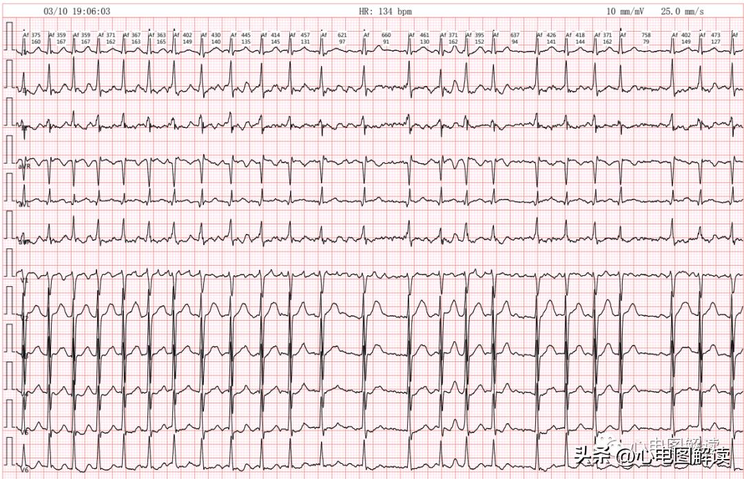 心房颤动伴长间歇心电图,心房颤动伴长间歇是什么意思