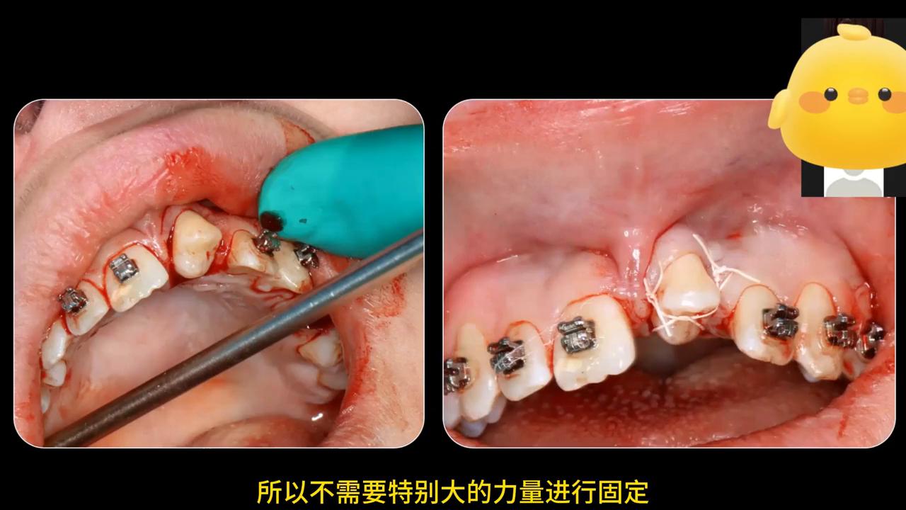 真实种牙视频全过程,种牙后悔的真实案例分析