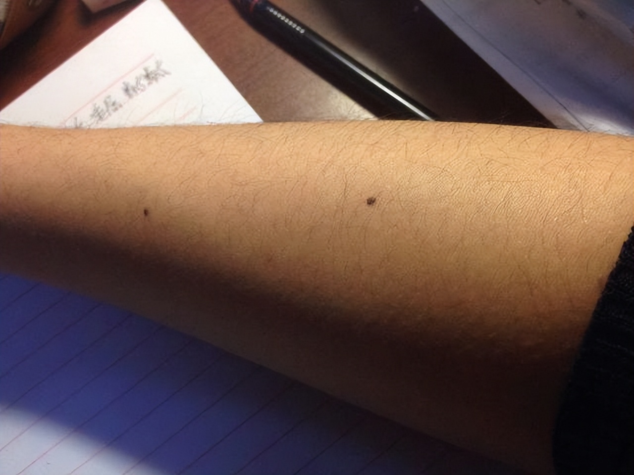 身上这3个地方长痣癌症可能来了,身上三个地方出现痣说明是癌变