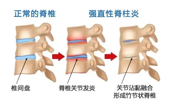 济南强直性脊柱炎脚后跟疼,强直性脊柱炎引起脚跟肿痛