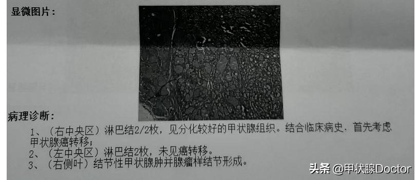 甲癌手术3个月后注意事项,甲癌术后5年生存期什么意思