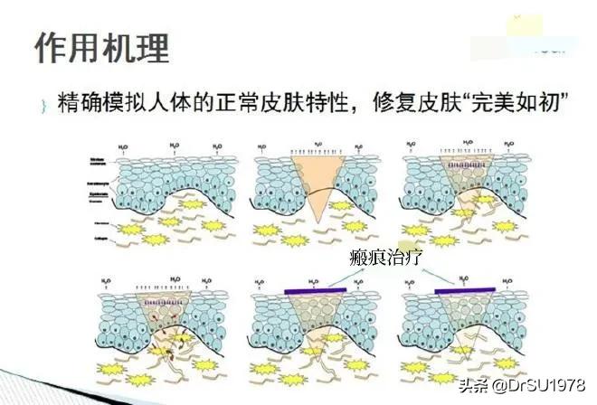 美丽怎能有瑕疵？瘢痕祛除有办法