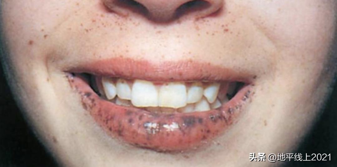 唇色深怎么办怎么变淡,唇色深怎么办四大技巧改善唇色深