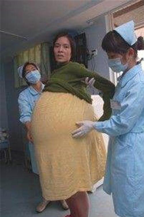 广东女子怀胎12个月肚子重达50斤,广东女子挺50公斤肚子
