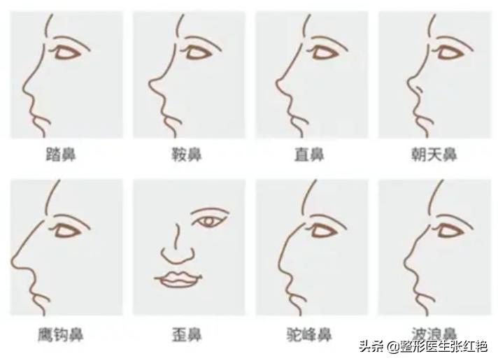 整容鼻子成功案例,鼻子整形有哪些鼻子形状