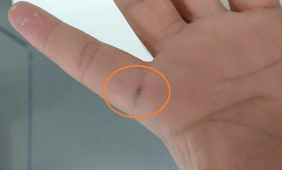 铅笔芯扎到皮肤里有黑点怎么处理,被铅笔扎了怎么处理不留黑点