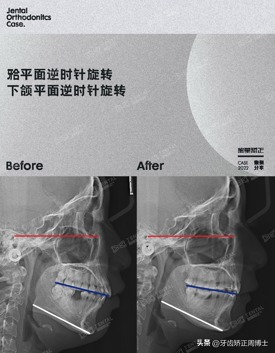 即刻种植即刻修复免受缺牙的痛苦,缺牙不补倾斜矫正价钱