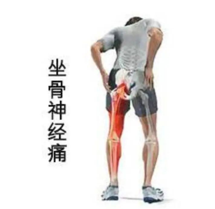 坐骨神经痛董氏针灸,董氏针灸治疗坐骨结节滑囊炎