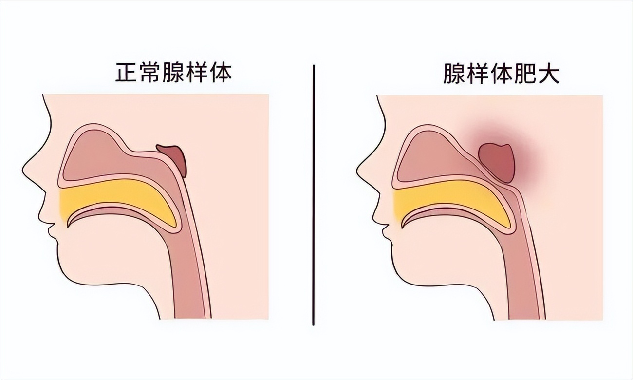 孩子腺样体肥大鼻窦炎家长经验,家长自测儿童腺样体肥大