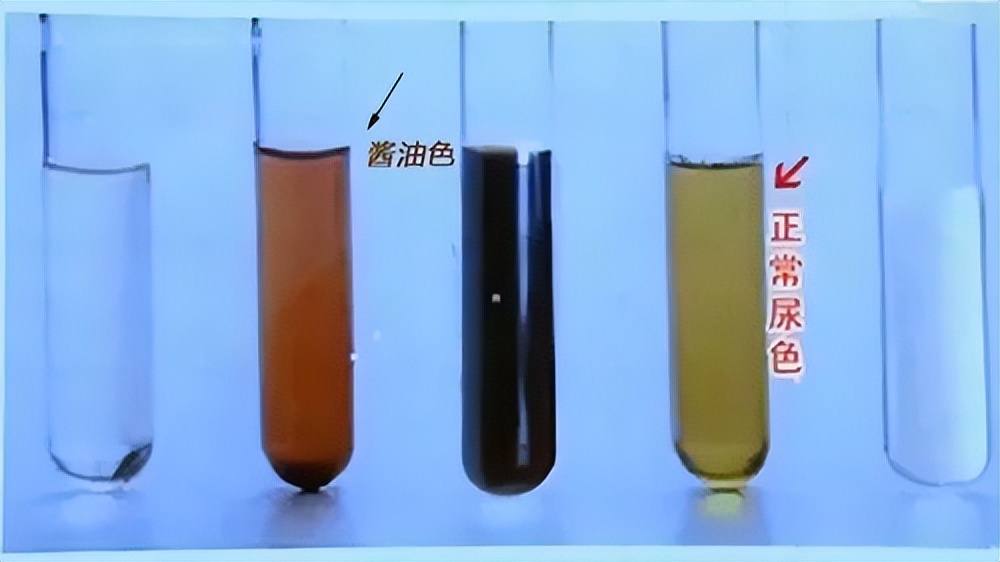 小便完还是一直有尿意查什么,尿液早期有4种信号