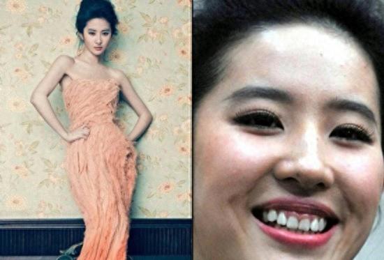 明星烤瓷牙发黑,明星烤瓷牙牙齿磨小后照片