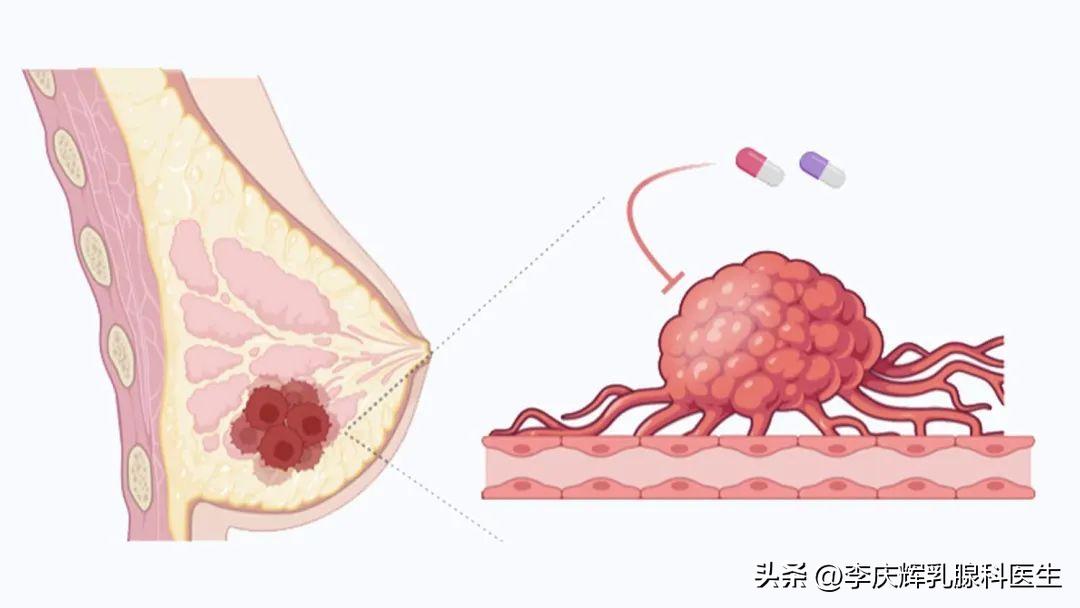 乳房疼痛是怎么回事乳腺增生,乳腺增生会出现乳房疼痛的症状