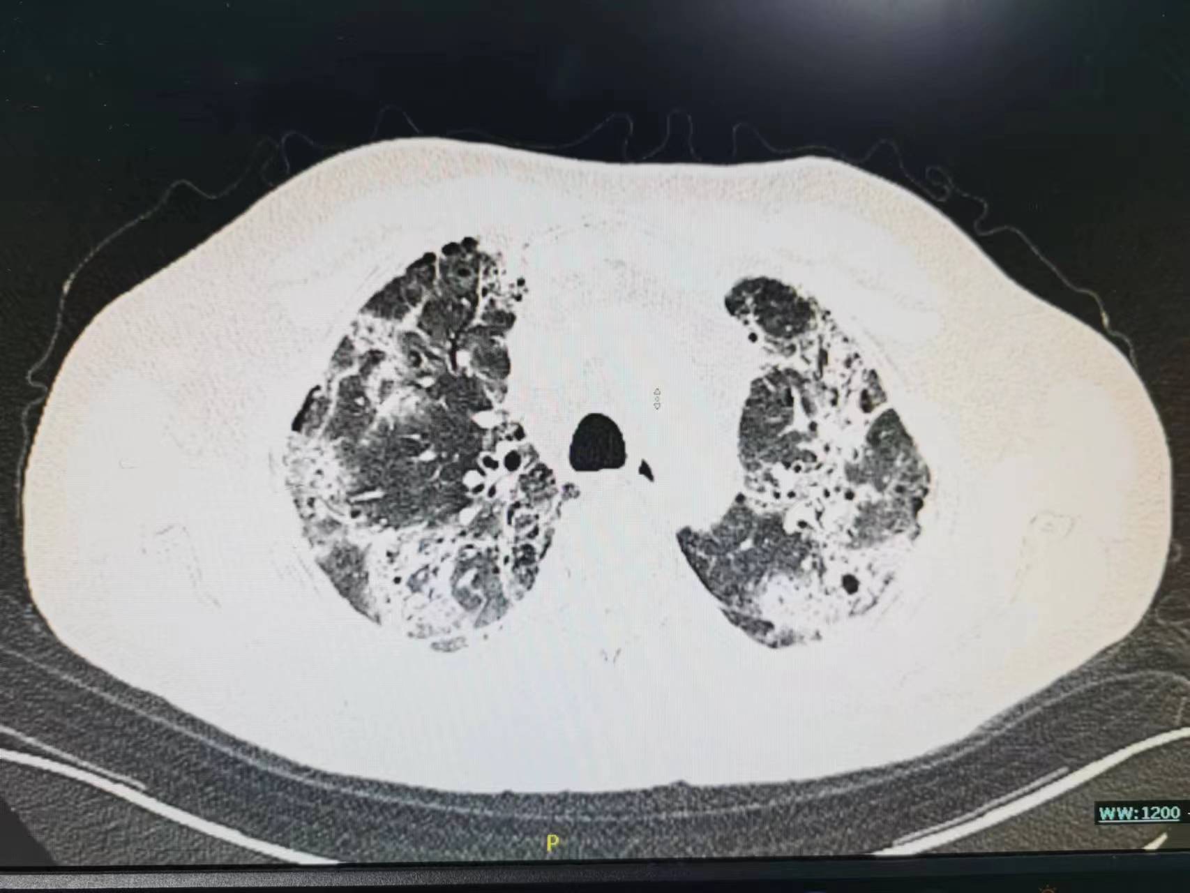 老年人发低热不退是什么原因,老年人阳了一直咳嗽怎么办