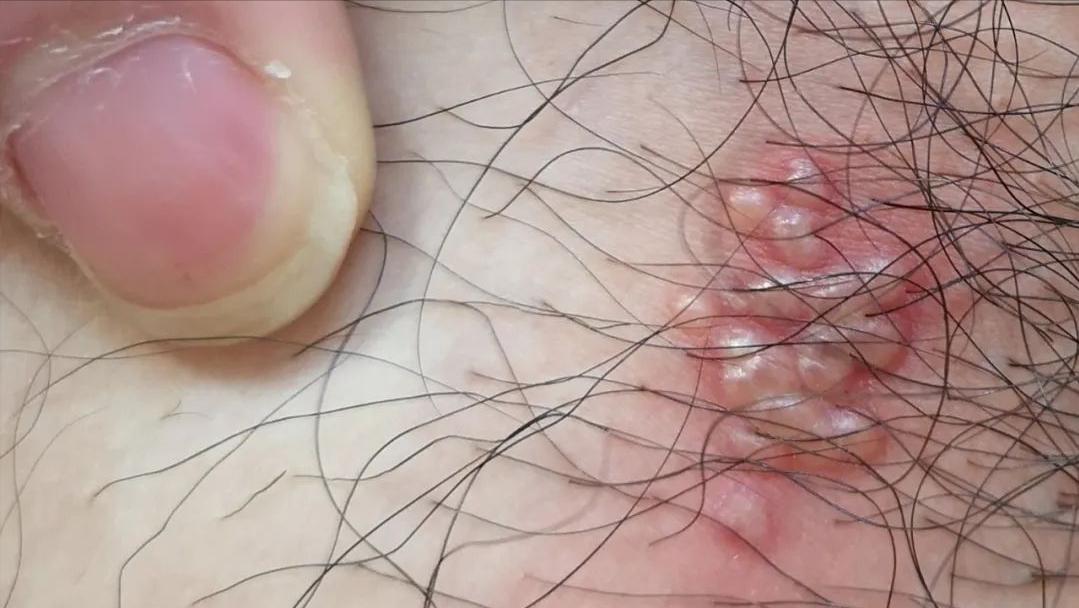 口唇边疱疹最好的治疗方法,口周疱疹