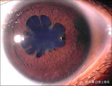 瞳孔变成三角形还能恢复吗,瞳孔变成了心形怎么回事