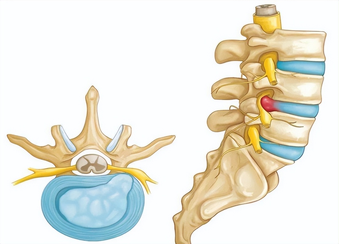 修复腰椎间盘突出，对症下药，多种手段齐上阵