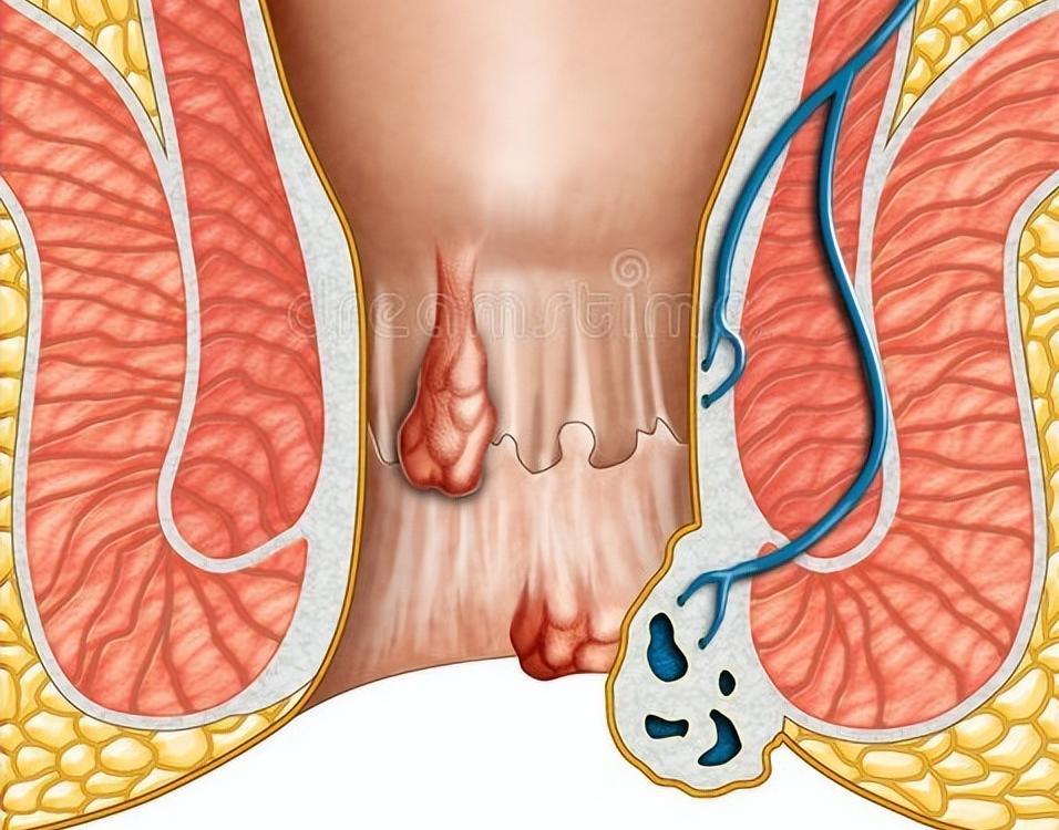 辣椒辣得肛门疼用什么药,辣椒辣到屁股最快消除方法