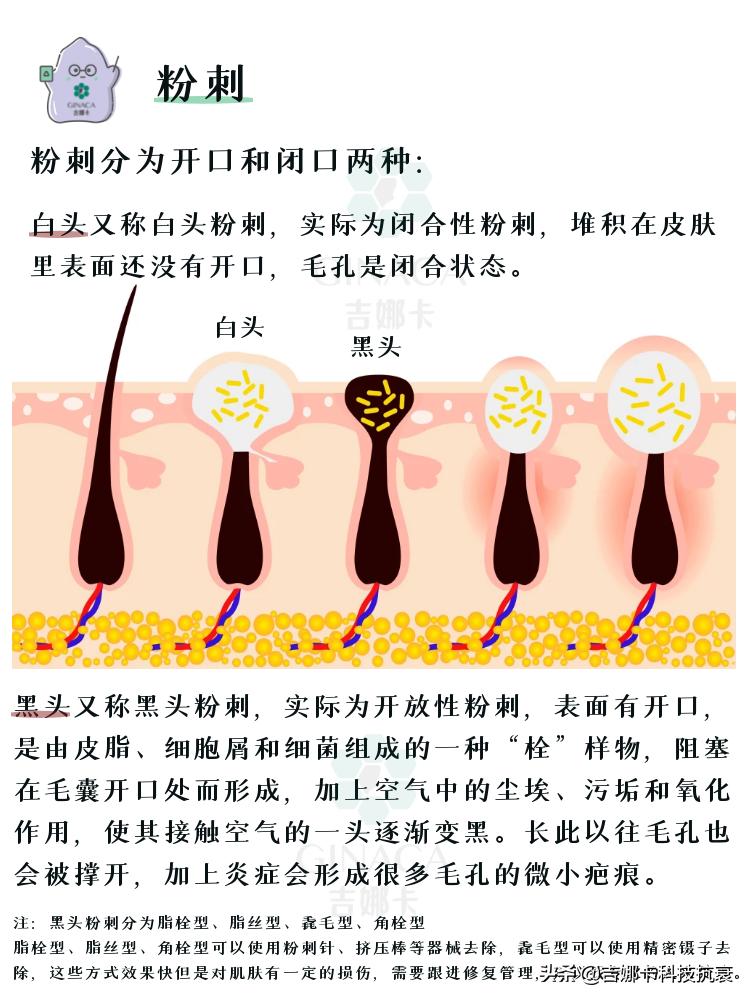 如何祛痘妙招,最简单高效祛痘方法