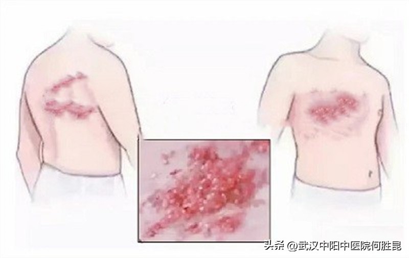 身上长了一片很疼的水泡是带状疱疹吗