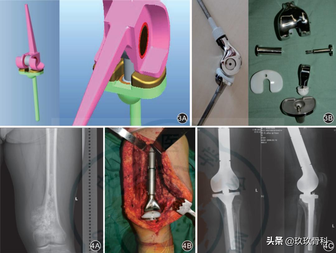 人工关节假体的诞生和发展,国产肿瘤型人工关节假体