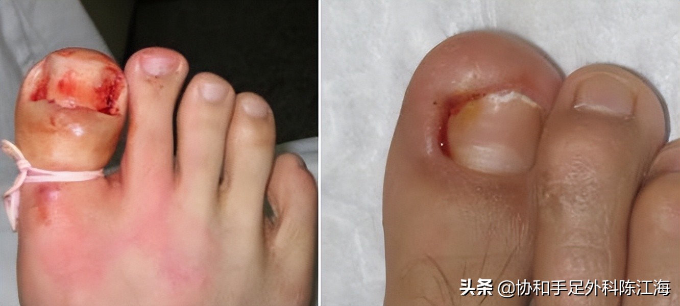 嵌甲怎么治疗才能彻底除根,嵌甲使用什么方法可以彻底根治