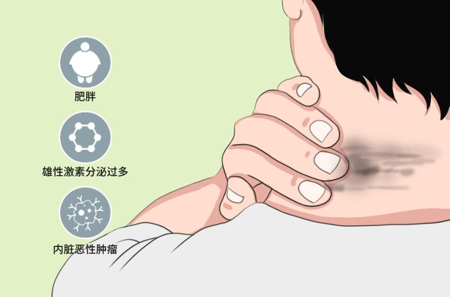 肥胖脖子很黑是不是因为肥胖引起,肥胖人群脖子发黑