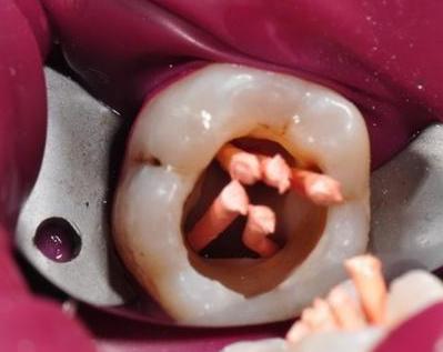 做了根管治疗的牙又开始痛了,牙做了根管治疗为啥还疼