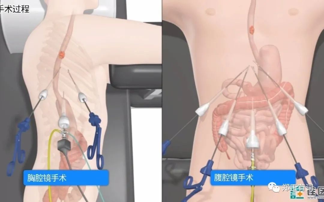 专题报道|食管癌术后吻合口瘘