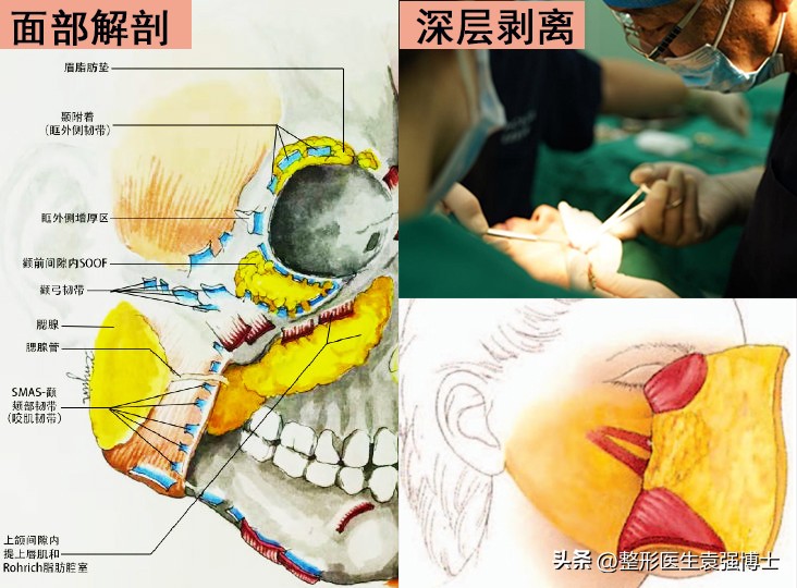 拉皮手术后的疤痕图片,耳前切口拉皮疤痕图片