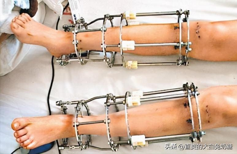 李亚诺断骨增高怎样了,断骨增高手术的李亚诺现状