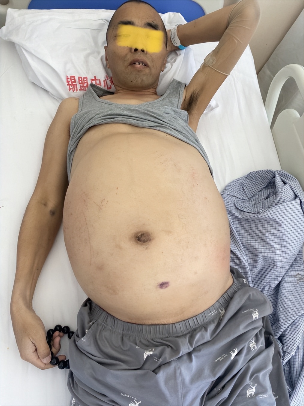 男子肚子大怎么办,男人肝腹水肚大如怀孕