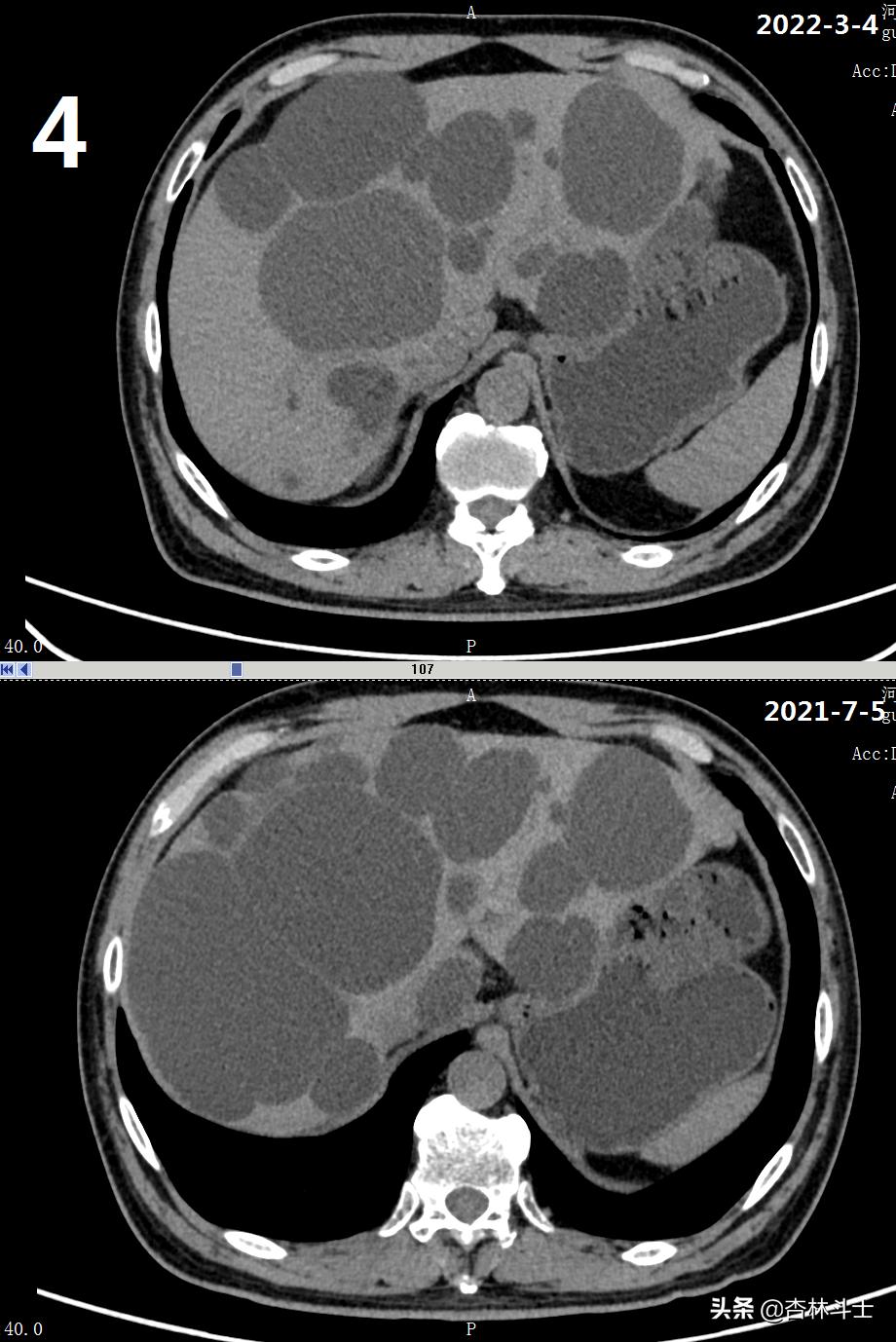 64岁银行职员患肝囊肿，CT引导下细针穿刺抽吸酒精硬化解决大问题