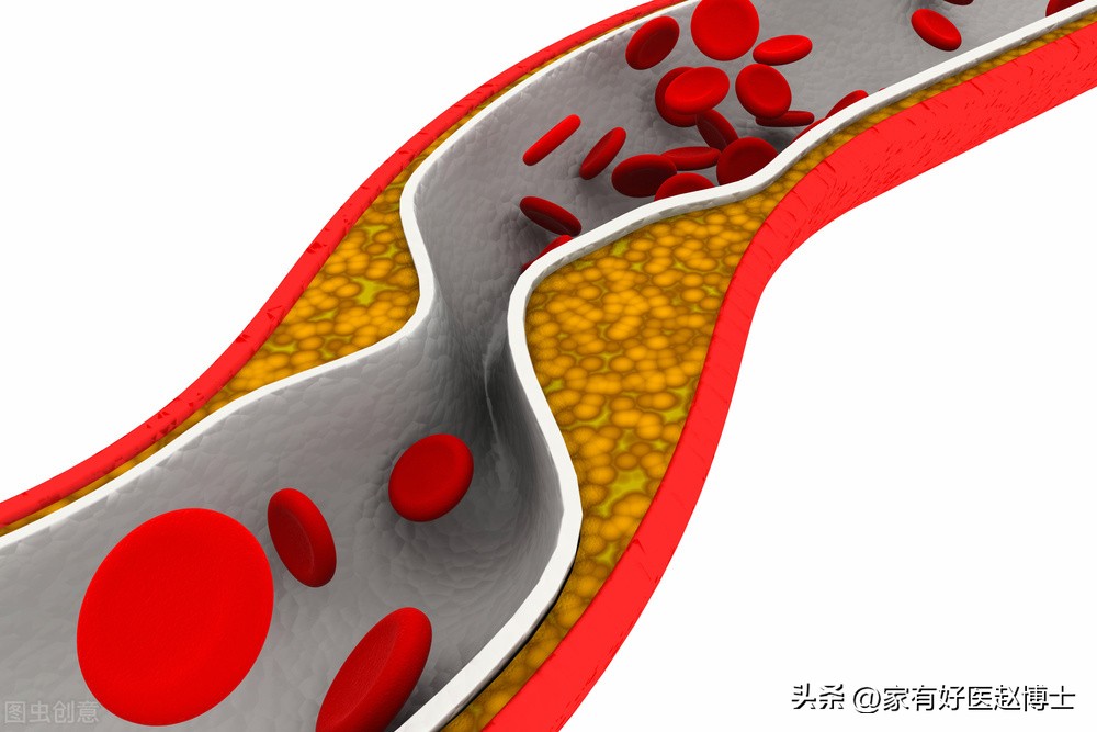 有动脉斑块必须要吃阿司匹林多久,有颈动脉斑块吃阿司匹林可以吗