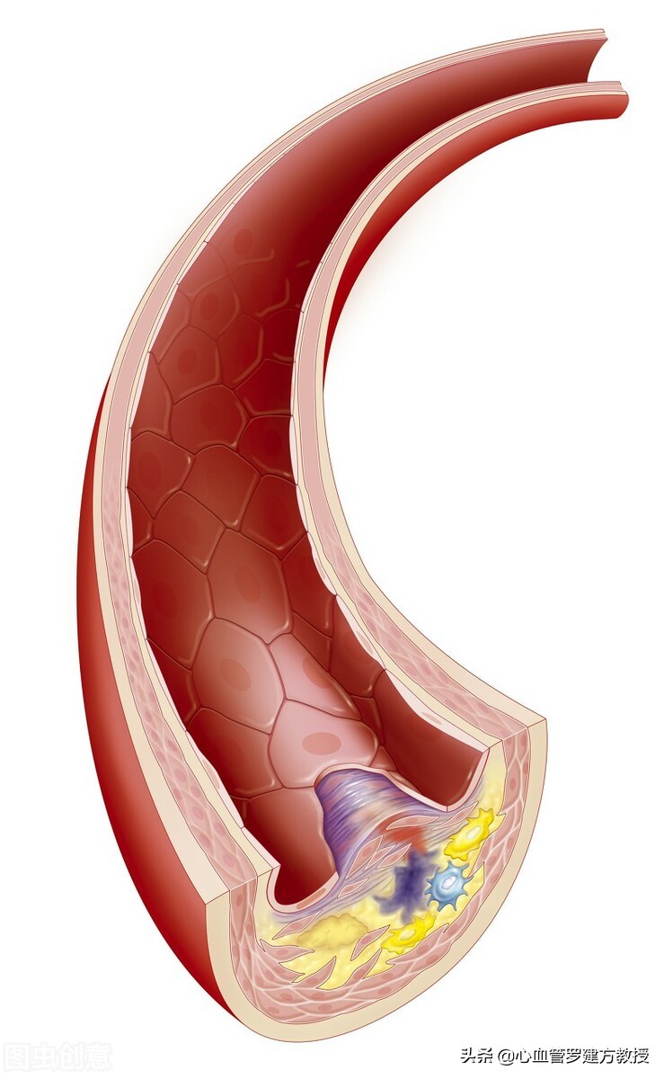 主动脉夹层动脉瘤什么原因造成的,主动脉夹层动脉瘤是什么症状