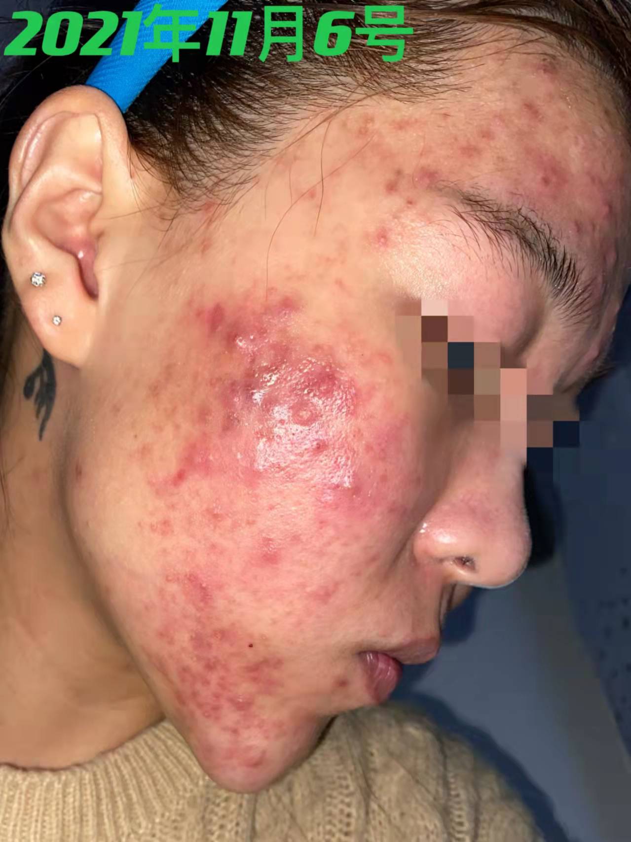 28岁女脸上反复长痘怎么办,28岁痘痘反复长是什么原因