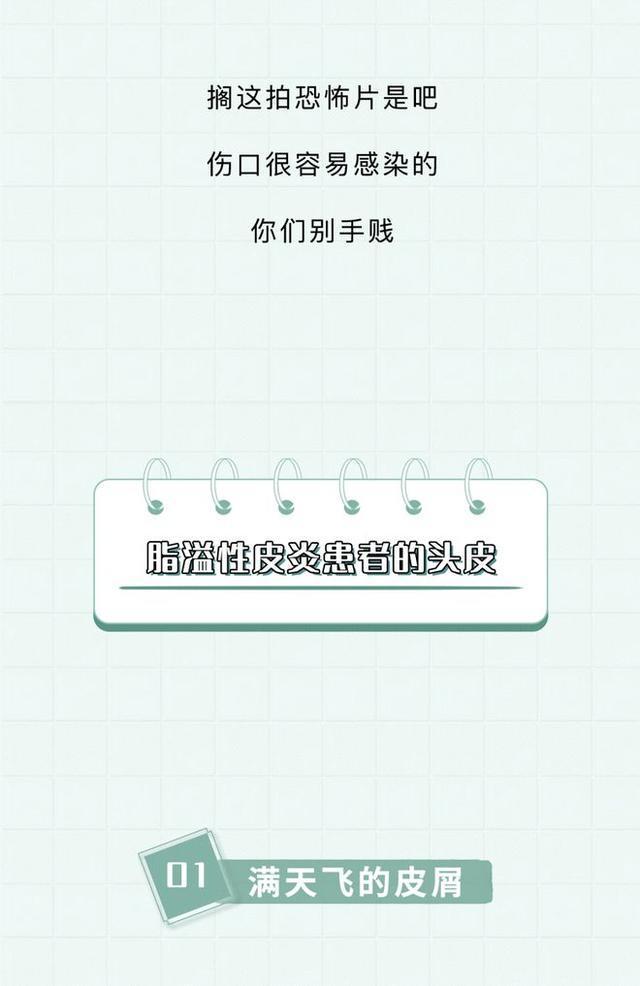 头皮上白色的小颗粒可以抠下来,为什么抓头皮会有白色小颗粒