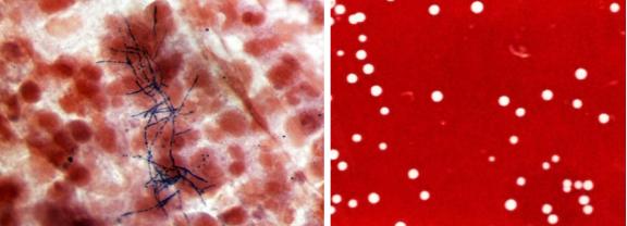 免疫缺陷病会并发什么病,什么是免疫缺陷肺部感染