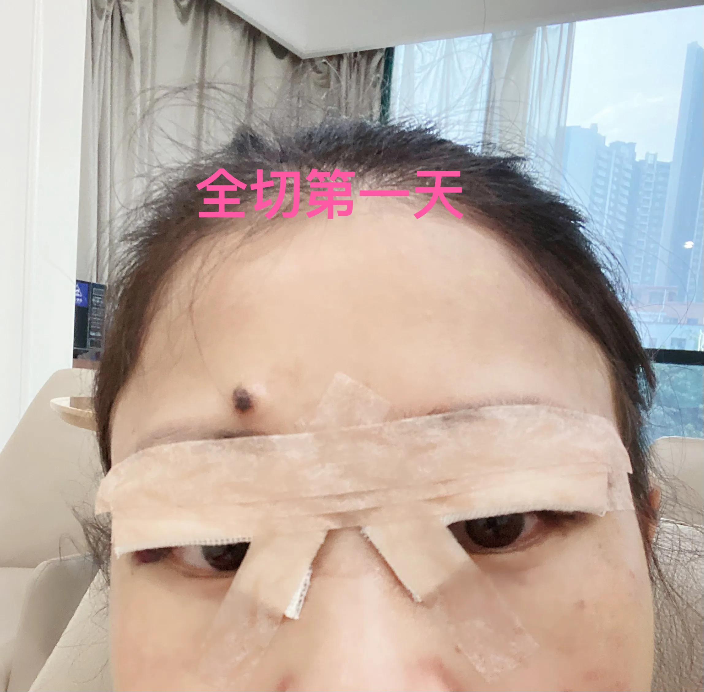 做双眼皮恢复期间能吃红糖吗,恢复最快的双眼皮