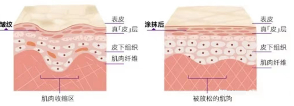 孕期预防妊娠纹小妙招,孕妇怎么防妊娠纹用什么