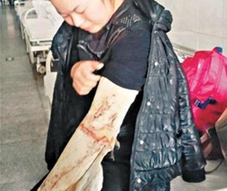 河南男子掉入油锅后来怎么样了,河南男子掉进油锅