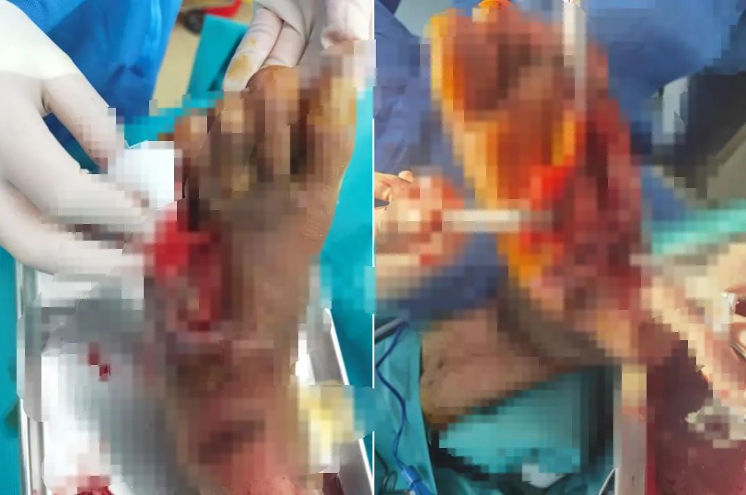 脚底水泡挑破后很难愈合,脚底磨出的大水泡不挑破会自愈吗