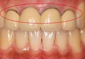 烤瓷牙什么情况要拆除,烤瓷牙崩瓷了要修复多少钱