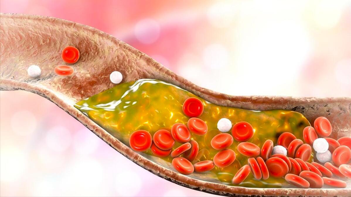 长期吃他汀，如何避开肝损伤和肌肉痛？做好这4点，助力用药安全