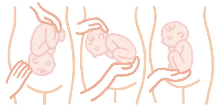 医生帮孕妇挪胎位,孕妇胎位不正医生手动转正胎位