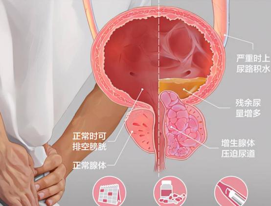 一位单身女青年的疑问：同房时，男人射精和尿尿会同时发生吗？